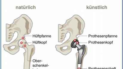 Knstliche Hfte: Die richtigen Fragen zum Implantat stellen