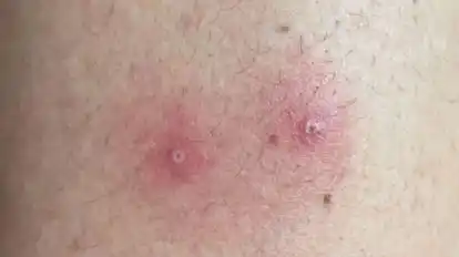 Affenpocken verursachen solche Hautsymptome.