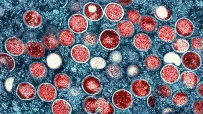 Die elektronenmikroskopische Aufnahme zeigt Partikel des Affenpocken-Virus (rot), die in einer infizierten Zelle (blau) gezüchtet wurden.
